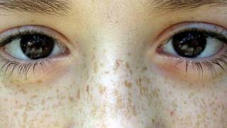 DermTV  Difference Between Freckles and Moles DermTVcom Epi 344 [upl. by Alida]