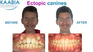 Ectopic canines [upl. by Yhprum]