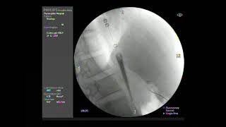 EGD  Pneumatic dilatation for Achalasia [upl. by Yliab]