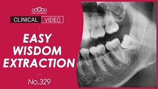 Easily Simplify Wisdom Tooth Extraction with the Coronectomy Technique Dr Cho Yongseok [upl. by Allyson]