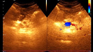 Ultrasonogram of Chronic Pancreatitis Key Findings and Diagnosis  Chronic Pancreatitis [upl. by Sallyanne979]