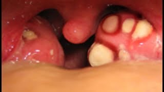 Worst Tonsil Stones Tonsillolith Questions amp Answers 😱😱😱😱 [upl. by Jolanta191]