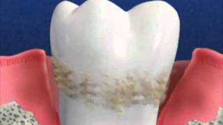 What is Alternative to Periodontal Gum Disease [upl. by Enrobialc]