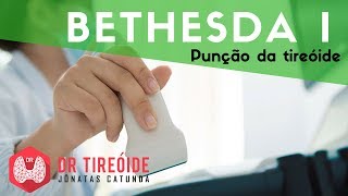 PAAF da tireóide Bethesda I  Material insatisfatório  Dr Jônatas Catunda [upl. by Osnofledi]