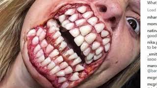 Extreme Dental Plaque Hyperdontia and Removals [upl. by Elery652]