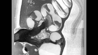 MicroCT of Cochlea after 4ul of Contrast Enhanced Endolymph Injected [upl. by Adlare444]