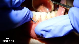 How Buildup Is Satisfyingly Removed From Teeth [upl. by Lugar]