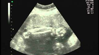 Ultrasound scan at 33 week pregnancy [upl. by Aneeb]