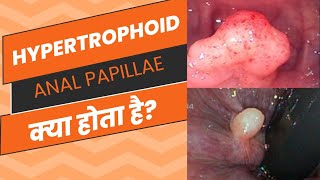 Anal Papillae क्या होता हैhypertrophoid papillae fissure chronic piles symptoms fistula [upl. by Anjali]