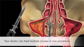 Balloon Sinus Dilation from Entellus [upl. by Eimmat]