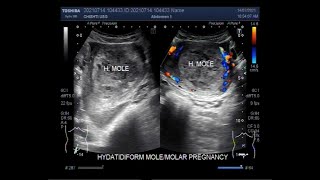 Complete Hydatidiform Mole also called Molar Pregnancy [upl. by Katz]