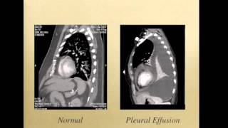 Thoracentesis [upl. by Fransen838]