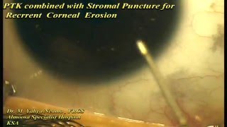 PTK with stromal Puncture for RCE [upl. by Tobi]