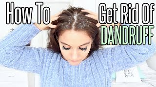 How To Get Rid Of Dandruff PERMANENTLY At Home [upl. by Mckeon]