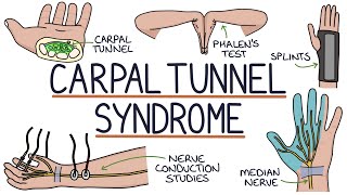 Understanding Carpal Tunnel Syndrome [upl. by Lemej]