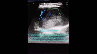 Warthin Tumor Parotid Gland Ultrasound [upl. by Acnairb]