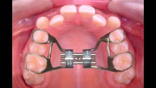 Rapid Palatal Expander [upl. by Olfe]