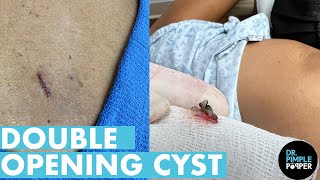 Double Opening Back Cyst [upl. by Pease]