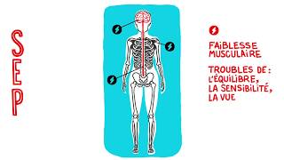 Comprendre la SEP en animation vidéo [upl. by Hbahsur]