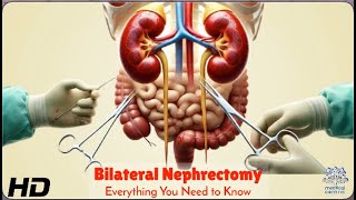 Bilateral Nephrectomy The Lifesaving Surgery You Didn’t Know About [upl. by Hashimoto]