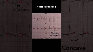 Acute Pericarditis ECG Concave upward STsegment elevation [upl. by Treblah]