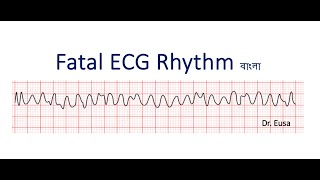 Fatal ECG Rhythm [upl. by Urbannai]