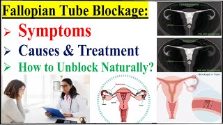 Fallopian Tube Blockage Symptoms Causes Diagnosis amp TreatmentHow To Open Blocked Fallopian Tubes [upl. by Kast]