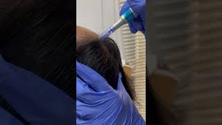 Stem Cell Hair Mesotherapy  Sarojini Skin Care  Dr Prateek Maharana [upl. by Yerd]