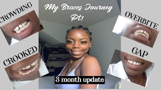 BRACES JOURNEY for EXTREME overbite gap and crooked teeth PT1 3 month update [upl. by Rednal]