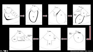 Intracardiac Echocardiography in EP Procedures  How can it help [upl. by Fakieh]