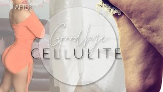 Say Goodbye to Cellulite Simple Steps for Smooth Skin  MUST WATCH [upl. by Aveer]