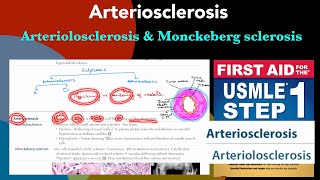 Arteriosclerosis Arteriolosclerosis vs Monckeberg sclerosis in HindiUrdu by first aid for step 1 [upl. by Swerdna]