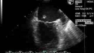 Ruptured Papillary Muscle on Echocardiogram [upl. by Saxena185]