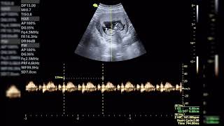 ECOGRAFÍA DE 11 SEMANAS DESCARTANDO PATOLOGIA CARDÍACA [upl. by Schoof]