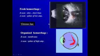 Ophthalmic ultrasonography  2vitreous cavity [upl. by Maddeu]