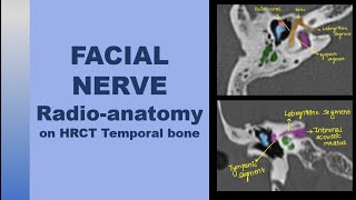 FACIAL NERVE Radiology  Anatomy on HRCT Temporal bone Segments amp course of facial nerve [upl. by Bigod]