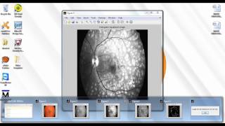 diabetic retinopathy detection using matlab codefinal year ece projects at bangalore [upl. by Ijuy]