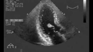 spontaneous rupture of a papillary muscle [upl. by Mcguire401]