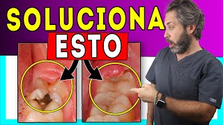 🚩Encía 𝐈𝐍𝐅𝐋𝐀𝐌𝐀𝐃𝐀 Muela del Juicio 💊Tratamiento de 𝙋𝙀𝙍𝙄𝘾𝙊𝙍𝙊𝙉𝘼𝙍𝙄𝙏𝙄𝙎 del tercer molar 𝗦𝗨𝗣𝗘𝗥𝗖𝗹𝗮𝗿𝗼 👌 [upl. by Nesta]