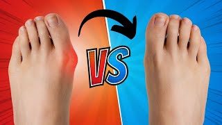 How To Fix A Bunion In 5 Steps [upl. by Mast]