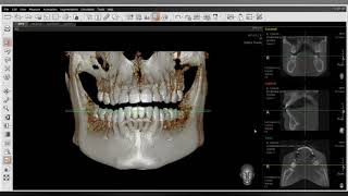 Tomografía odontológica VATECH Ez 3Di Simple Viewer [upl. by Otsedom]