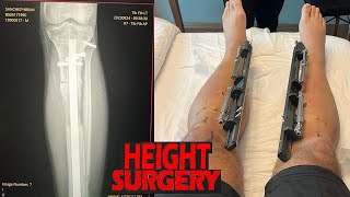 Limb Lengthening Surgery is Insane [upl. by Hilaria]