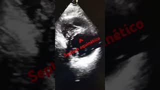 ANTEROSEPTAL FACE INFARCTION echocardiogram infarto anteroseptal [upl. by Norri]