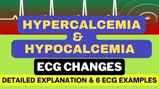 Hypercalcemia and Hypocalcemia ECG changes with 6 Examples Mechanism and Detailed Explanation [upl. by Malony]