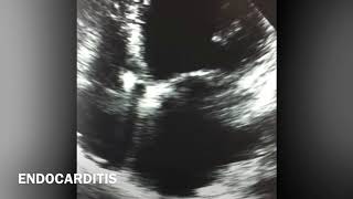 Vegetation on Pacemaker wire VS RA thrombus [upl. by Mogerly]