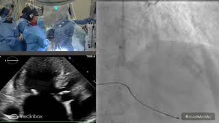 Alcohol Septal Ablation To A Patient With HOCM And MR [upl. by Sugar]