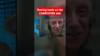 Rotting teeth on the CARNIVORE diet carnivore ketodiet keto [upl. by Ytsud]