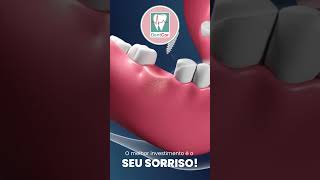 IMPLANTE DENTÁRIO COMO SURGIU  DENTCOR CLINICA MÉDICA E ODONTOLÓGICA EM SANTO ANDRÉ [upl. by Navek]