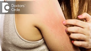 5 Top Causes of Itchy skin  Dr Urmila Nischal [upl. by Leahcimed]