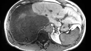 Dedifferentiated Retroperitoneal Liposarcoma [upl. by Ahsitaf619]